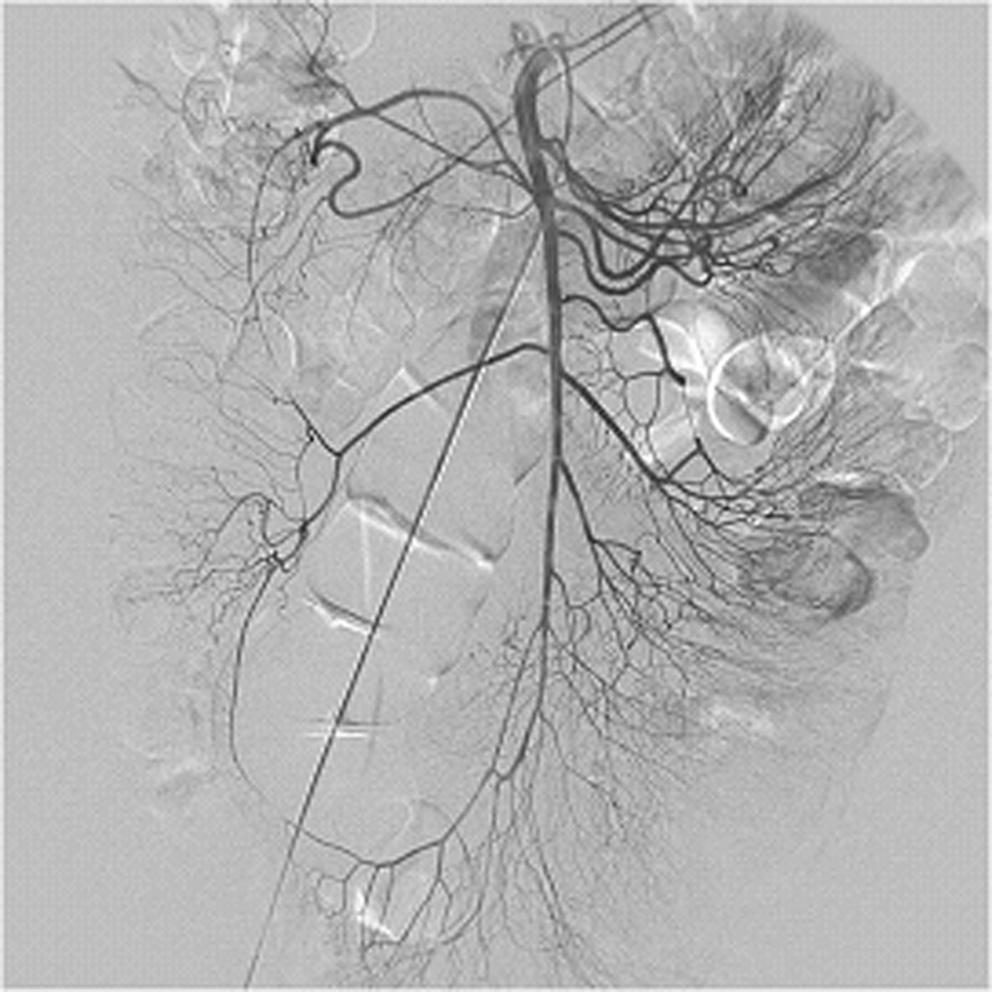 A B Fig. 3. GIST in a 72-year-old man presenting acute GI bleeding. A. Angiography performed at outside hospital showed no bleeding foci. B. When this patient was transferred to our hospital, CT was performed, first.