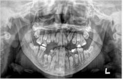 J Korean Acad Pediatr Dent 36(3) 2009 Fig. 13. Panoramic view and intraoral photograph after surgical exposure of maxillary anterior teeth. Fig. 14.