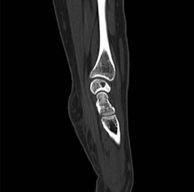 Figure 2. Osteolytic lesion (0.