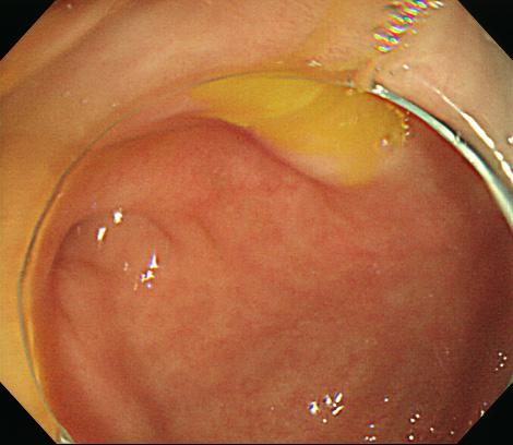 - Yu Yi Choi, et al. Appendicitis presenting as a sigmoid SEL - 충수염이진단되기도한다. 이러한경우관찰되는대장내시경소견은충수돌기개구부의융기, 발적과부종, 화농성삼출물등이대표적이다 [2].