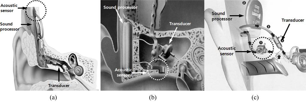 Proposition of a New Implantable Acoustic Sensor Based on Technology Evaluation of Fully Implantable Hearing Aids I 31 I Fig. 1.