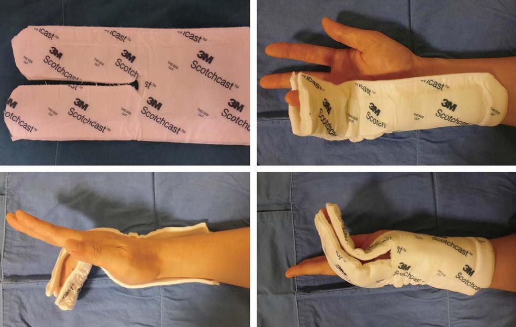 Ho-Jin Gil, et al. Modified Split Ulnar Gutter Splint for Treatment of Fifth Metacarpal Neck Fractures Fig. 2. Molding method of modified split ulnar gutter splint. Table 1.