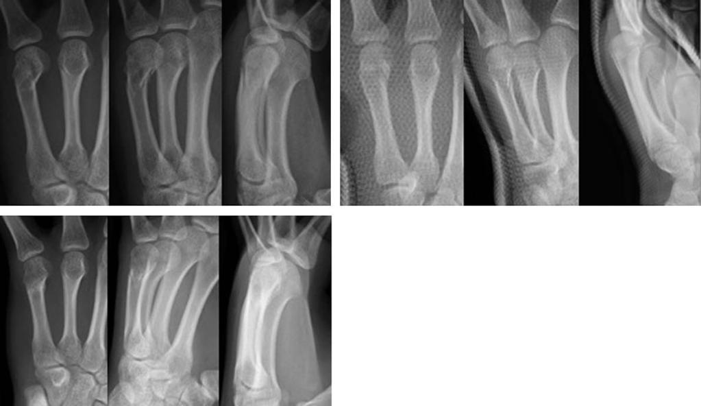 J Korean Soc Surg Hand Vol. 20, No. 4, December 2015 Fig. 3. (A) A 50-year-old man sustained a fifth metacarpal neck fracture with 24.