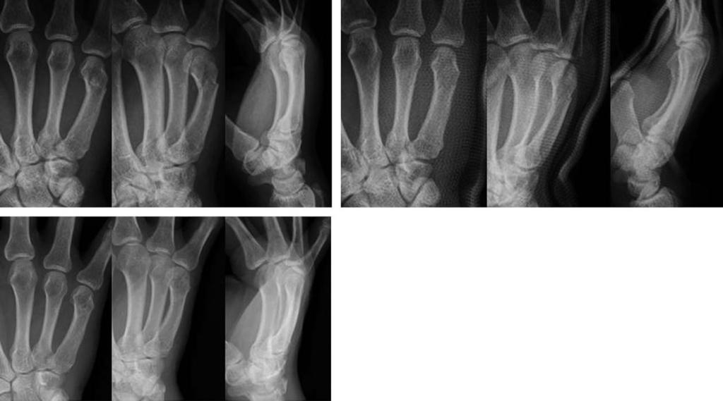 (C) 24-month follow-up radiographs show good union without any reduction loss or rotational deformity. Fig. 4. (A) A 28-year-old man sustained a fifth metacarpal neck fracture with 16.