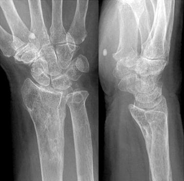 (A) Sixty-nine year old female patient had broken her right wrist, with severe intraarticular fracture of distal radius.