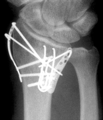(D) Trimed System R (Trimed, Valencia, CA) was applied to the severely comminuted distal radius fracture. (E) Trimed and 2.