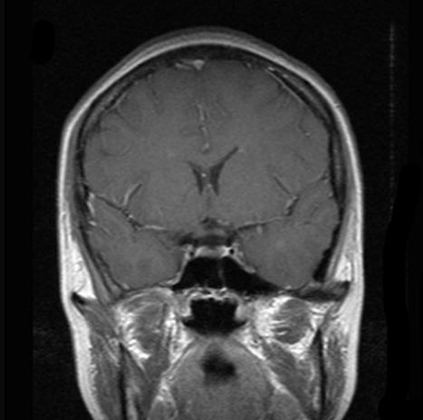 EDSS score 1.0 with a disease duration of 10 years.