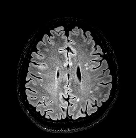 is generally decreased which is suggested by widened sulci, enlarged ventricles and cistern, and decreased