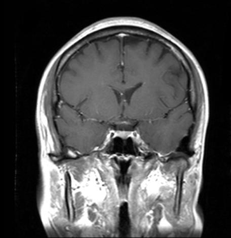 19 BMS에서피로감에대한연구는 Fatigue Severity Scale 혹은 Modified Fatigue Impact Scale을통해평가하였고약 40% 정도로보고되고있다.