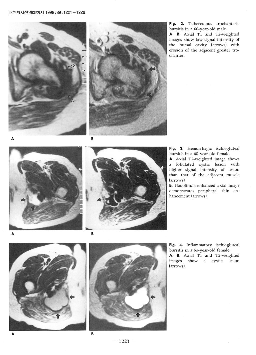 대한방시선의학회지 1998;39 : 1221-1226 Fig. 2. Tuberculous trochanteric bursitis in a 60-year-old male. A. B.