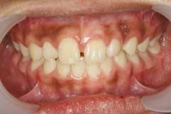 aspect. a Fig. 6. Panoramic view and intraoral photos taken at 2 year and 6 month check-up after removal of the appliance.