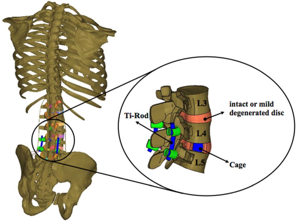 한국정밀공학회지제 35 권제 7 호 July 2018 / 723 Fig. 3 Fused segment of lumbar spine model. The paraspinal muscles and thoracolumbar fascia were removed for a clear view 근골격모델을보여주고있다.