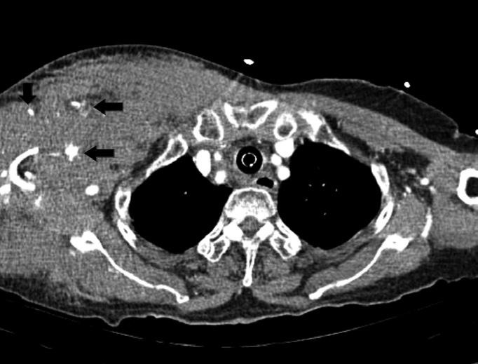 혈종형성원인에따른경동맥색전술 A B C Fig. 2. An 80-year old woman with anterior chest wall hematoma due to traffic accident. A. Multiple aneurysmal sac (black arrows) with extravasation at right posterior humerus circumferential artery and humerus comminuted fracture are present in the CT.