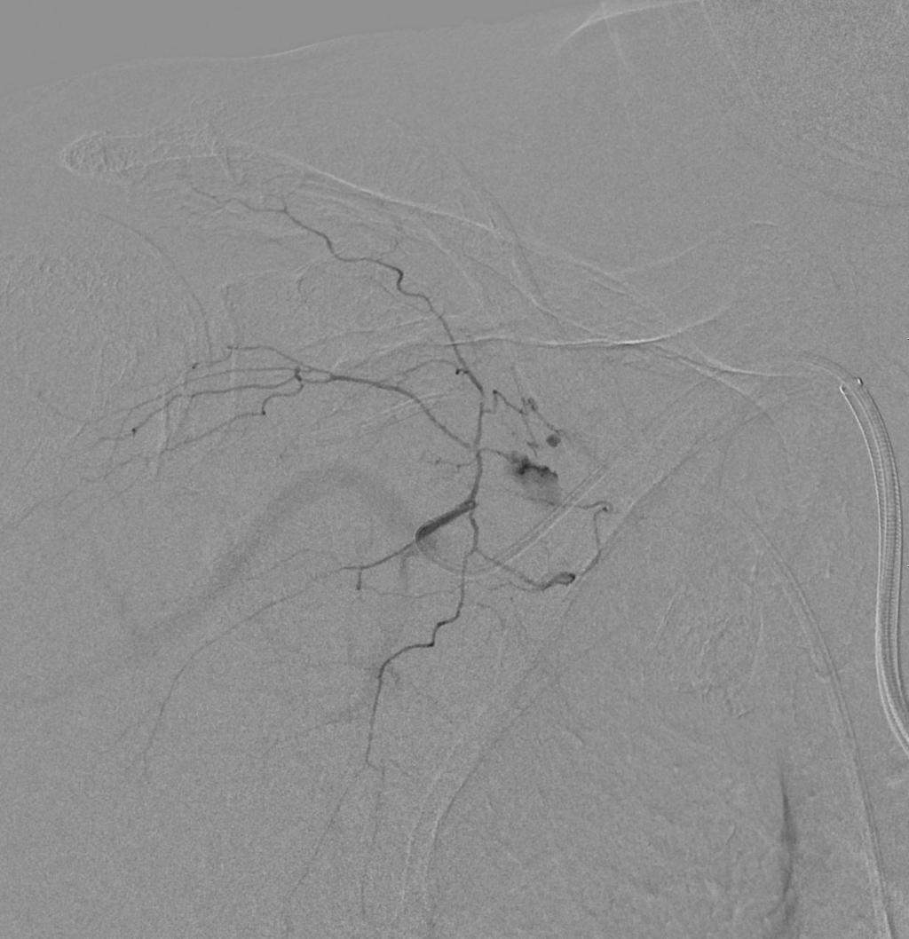김보람외 A B C D Fig. 3. A 75-year old woman with anterior chest wall hematoma due to complications of central line insertion. A. Huge anterior chest wall hematoma with about 18-cm-sized longest diameter.