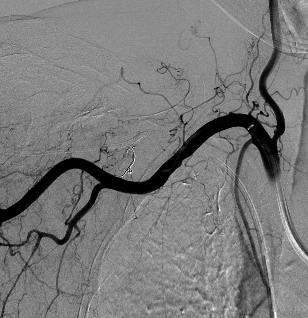. C. Contrast media extravasation at the right scapula subclavian artery branch is discovered during a selective angiography. D.