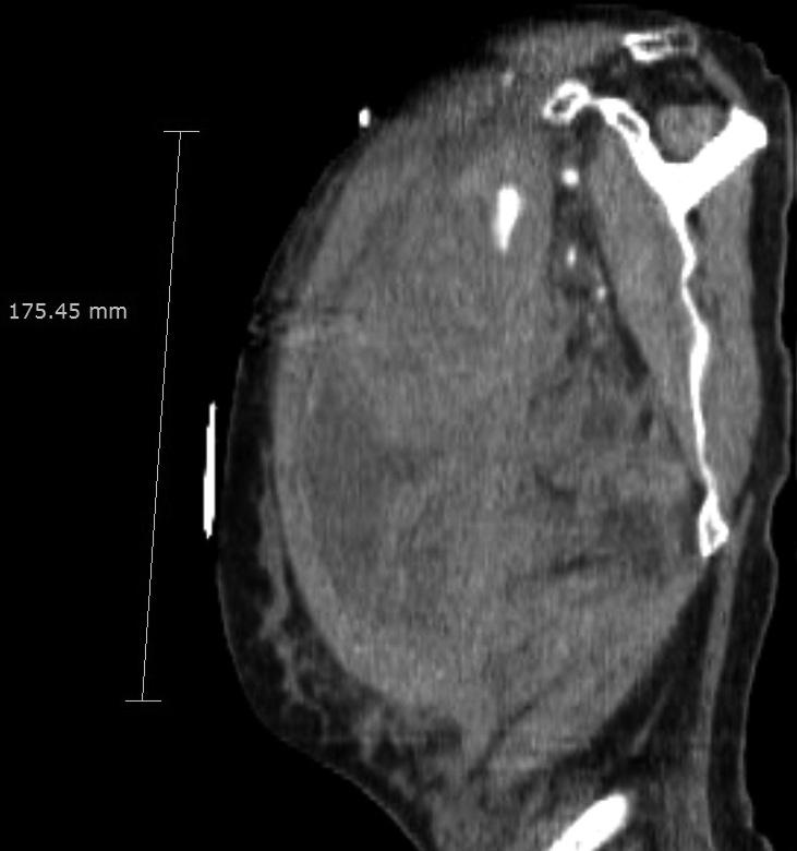 Lai 등 (23) 의연구에서는시술전 platelet 의개수는시술의임상적성공과실패를좌우하는중요한요인이라고하였으며, 프로트롬빈시간과피브리노겐의개수와더불어혈소판이혈액의응고에중요한역할을하기때문이라고밝혔다.