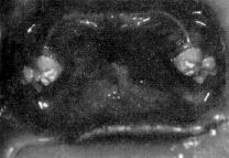 그림 6. 연구대상 2 환자의상악구내사진. 그림 8. 연구대상 2 환자의전의치의후방모습 posterior palatal dam 부위에 3~5mm 의간격을보였다. 그림7. 연구대상 2 환자의하악구내사진. 에 3~5mm까지의간격이생겨있었다.