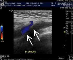 H. T. Kim et al 505 Wj ++/++ Kj ++/++ Aj ++/++ (5) Babinski sign: -/- 4) 허벅지, 종아리둘레 (1) Thigh L: 41.5 cm, R: 36.2 cm (2) Calf L: 34.