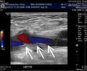 좌하복부압통 (9) 그외별다른특이사항없음 藥 0.024 g, 桃仁 0.024 g, 蘇木 0.016 g).