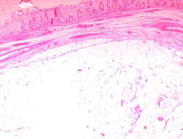 90%에서 점막하층에 국한되어 점막하 종양의 형태로 2 발견되나 일부는 장막하 종양으로 발견된다. 대장 지방 Figure 6.