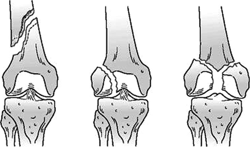 골절후발생하는변형은손상시받은힘과손상후근육의힘에의하여결정되는데이에중요한근육들은대퇴사두근 (quadriceps femoris), 내전근 (adductor), 슬괵근 (hamstring), 비복근 (gastrocnemius) 등이다.