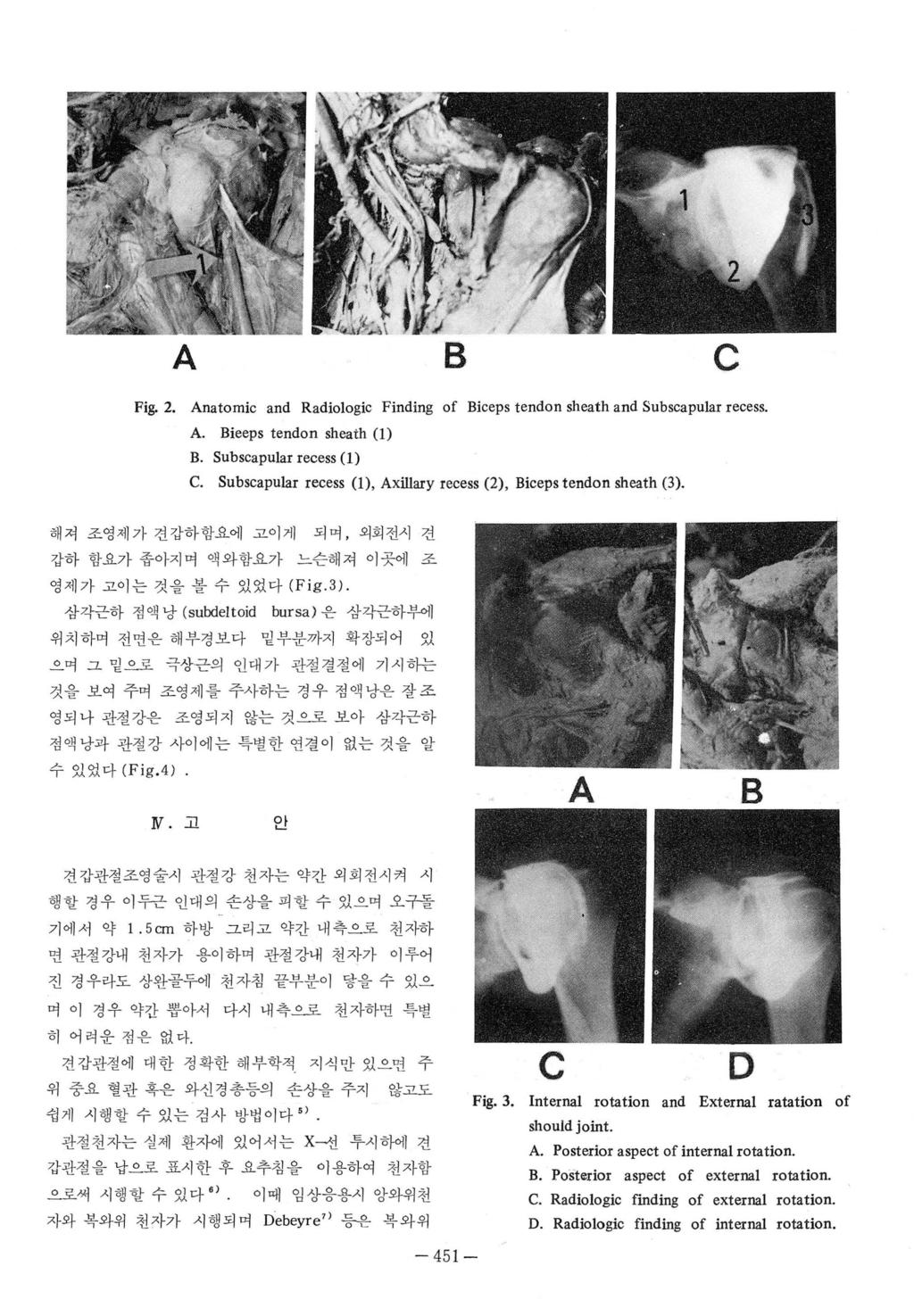 A B C Fig. 2. Anatomic and Radiologic Finding of Biceps tendon sheath and Subscapular recess. A. Bieeps tendon sheath (1) B. Subscapular recess (1) C.