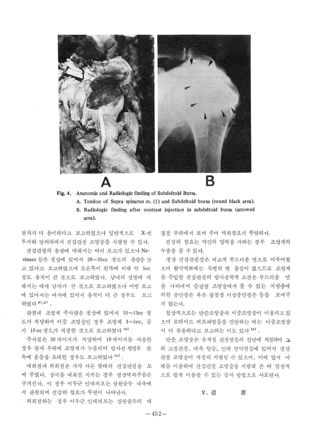 Fig. 4. A Anatomic and Radiologic finding of Subdeltoid Bursa. B A. Tendon of Supra spinatus m. (1) and Subde1toid bursa (round black area). B. Radiologic finding aft er contrast inj ection in subde1toid bursa (arrowed area).
