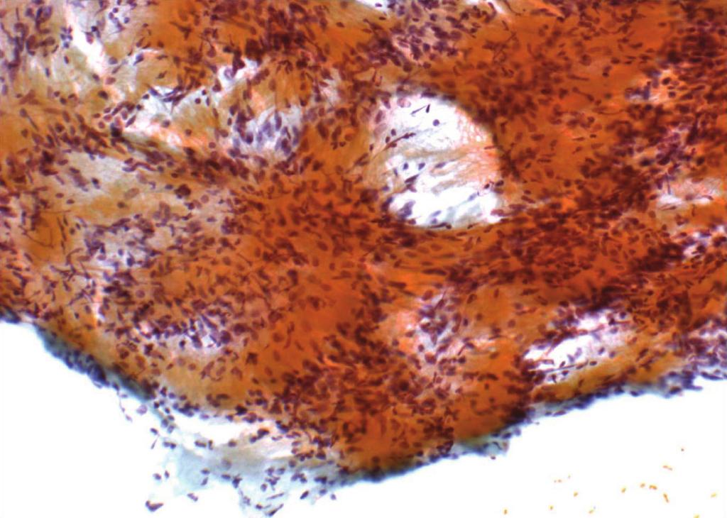 Fig. 4. Schwannoma.