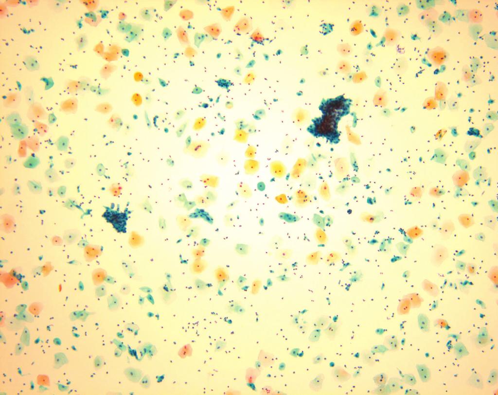 respectively Good None None Reduced Yes Possible in a 25 75 mm area Insufficient Usually present Usually present Usually long No +/- LBC, liquid based cytology; TP, ThinPrep; SP, SurePath.