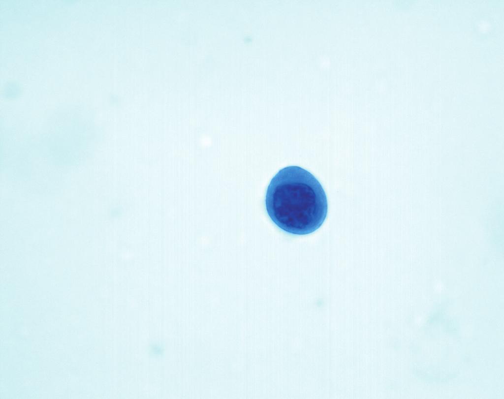 294 이용희 편평상피내병변의 형태 액상세포검사법에서 관찰되는 편평상피화생세포는 판상 혹은 자갈돌(cobblestone) 모양으로 배열하며 세포질이 짙고 균질하 며 세포질 내 공포 형성이 많이 되는 성향이 있다(Fig. 2).