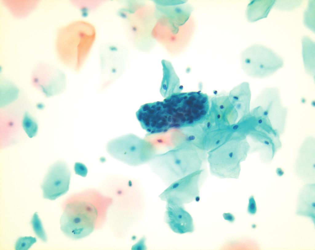 carcinoma 2D sheets Ragged group edges Dense, homogeneous cytoplasm Irregular nuclear shapes and sizes (tadpole, spindle cells) Nuclear pyknosis More single cells A B C D Fig. 3.