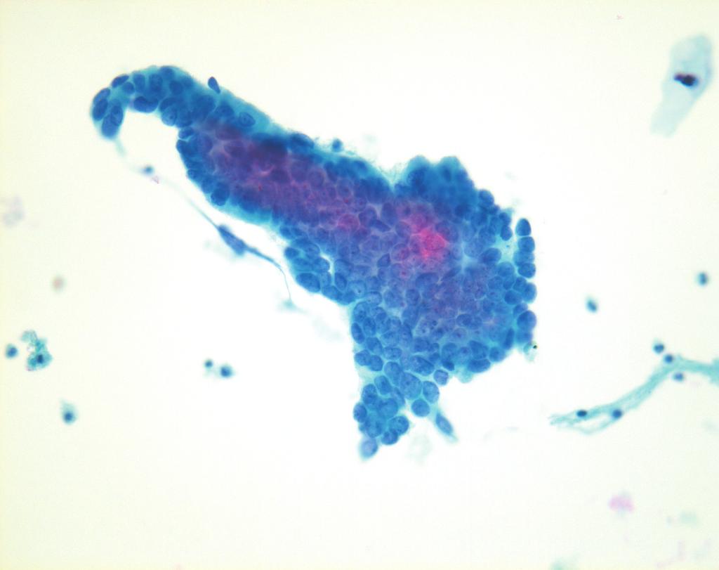 (D) Clustered columnar endocervical adenocarcinoma cells are shown with enlarged round to oval nuclei (Papanicolaou stain). Table 6.