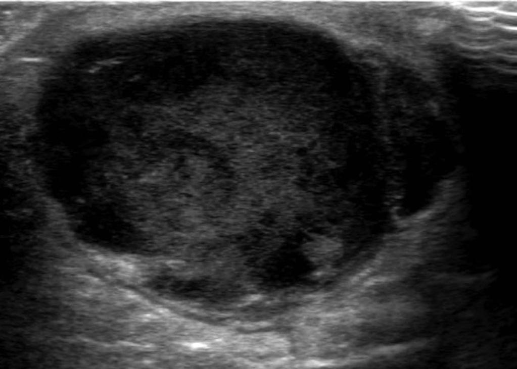 남성유방질환의영상소견 Fig. 12. Infected epidermal inclusion cyst in a 38-year-old man. On ultrasound (, ), a large mixed echoic mass is visible along the skin layer and overlying skin is thickened.