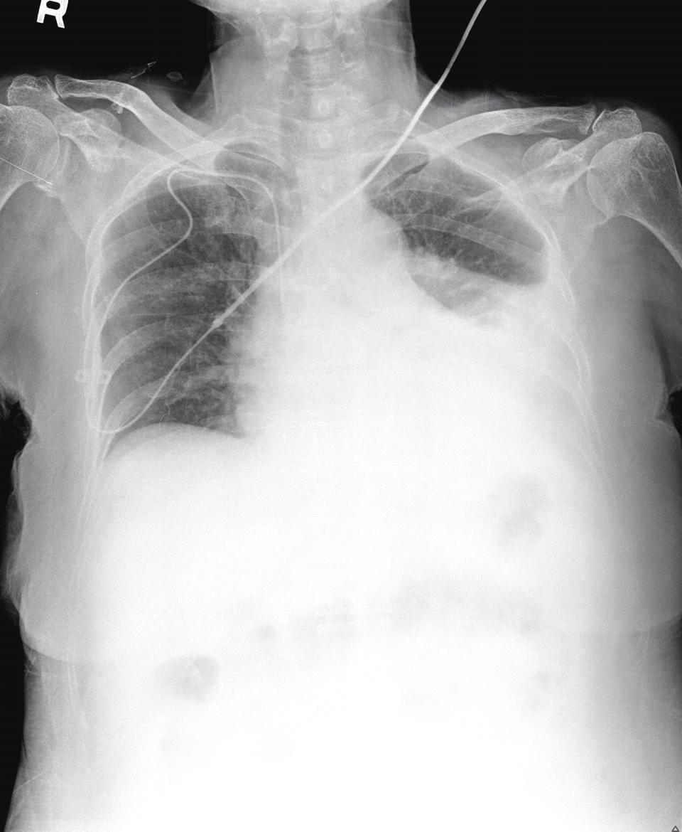 - 대한내과학회지 : 제 74 권부록 1 호 2008 - Figure 2. Abdominopelvic CT scan findings. Abdominopelvic CT scan shows ascites with diffuse colitis in the right colon. Figure 1. Chest PA findings.