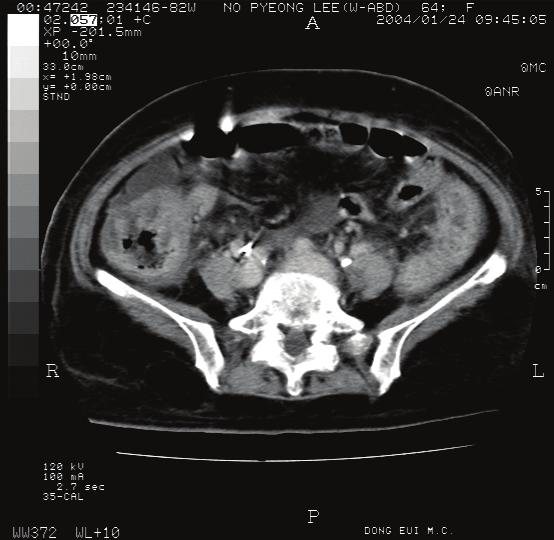 Sigmoidoscopy shows diffuse yellowish pus-like patchy membrane overlying the edematous mucosa. 진찰소견 : 활력징후는혈압 110/70 mm/hg, 맥박 72회 / 분, 체온 36.5, 호흡수 17회 / 분이었고, 의식은명료하였다.