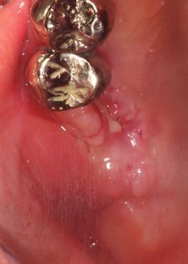 6). 메쉬를살짝들어올린후안쪽에방사선조사된수질골 (irradiate cancellous bone) 1.