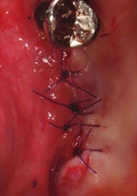 (B, C) primary closure after suture. Fig. 14.