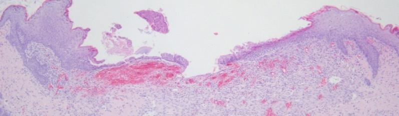 granulation tissue