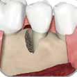periodontal ligament, alveolar bone 과같은치주조직의재생을돕습니다.