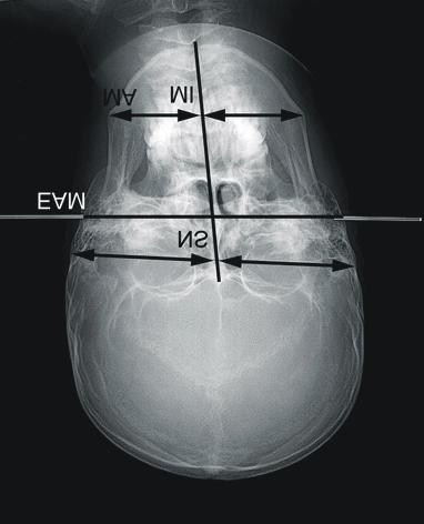 The difference in the cranial asymmetry length was calculated by subtracting the length of the normal side from that of the involved side and  (E)