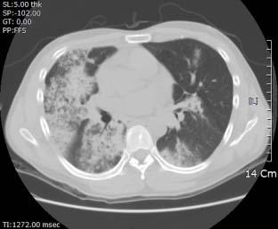 Ground-glass opacity and consolidative density with peribroncheal distribution is noted in right lower lobe.