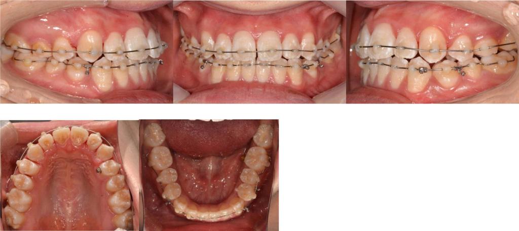 Interproximal reproximation was performed onto lower dentition and.