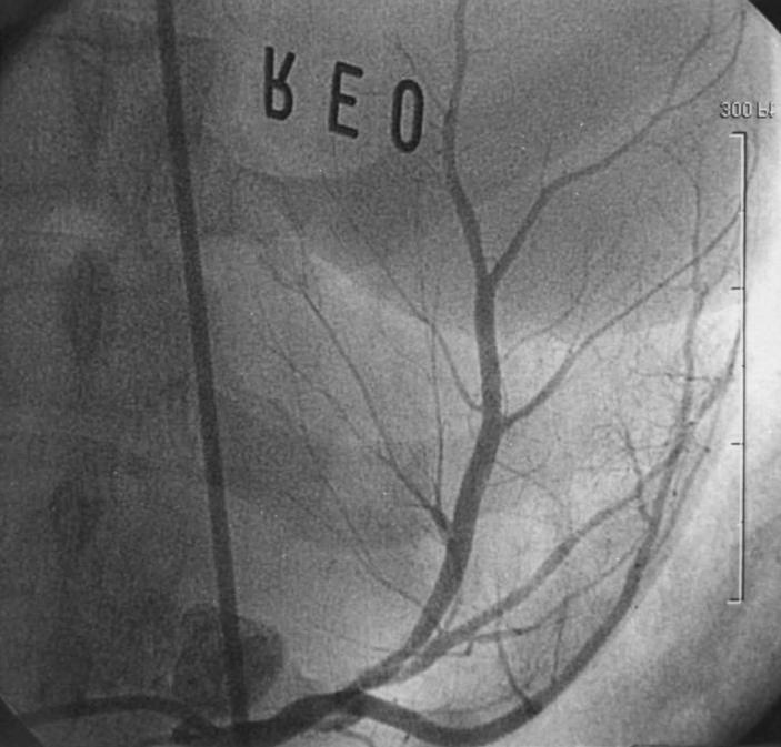 A Fig. 4. A 6-month follow up coronary angiogram revealed no restenosis in left anterior descending artery and the first diagonal branch. B Fig.