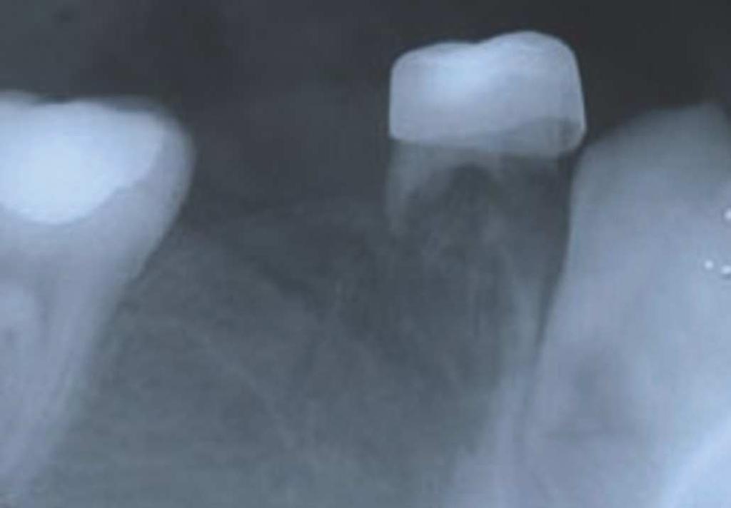 Fig. 4. Periapical radiographs. Bilateral lower first, second premolars are absent. a b c Fig. 5. Lingual frenectomy. (a) Preoperative state.