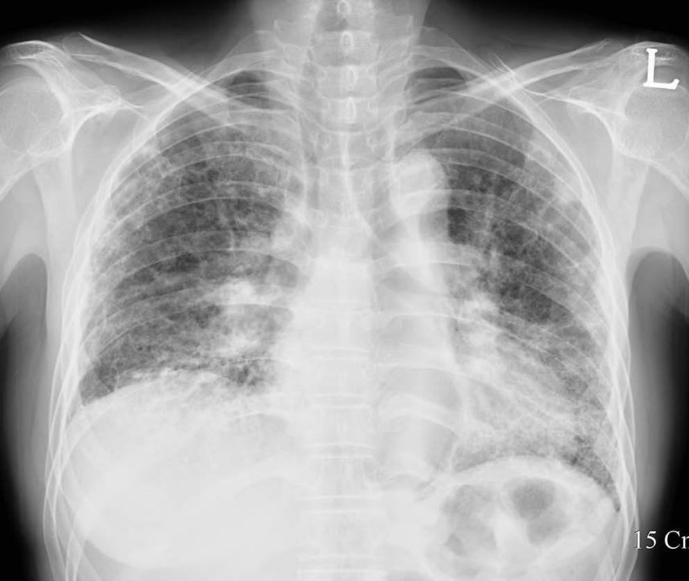 Fig. 4. Pulmonary fibrosis associated with progressive systemic sclerosis in a 50-year-old woman.