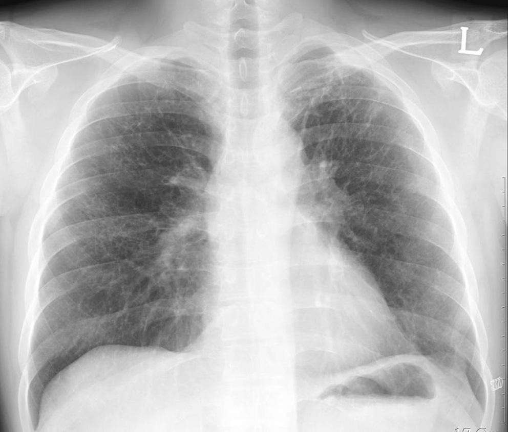 Moderate-sized cystic spaces are seen in mid and upper lung zone in a central distribution on chest radiograph.