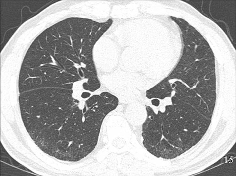 고해상CT에서 낭성음영 형태로 보이는 질환들로는 특 Fig. 15. Idiopathic pulmonary fibrosis in a 70-year-old man.