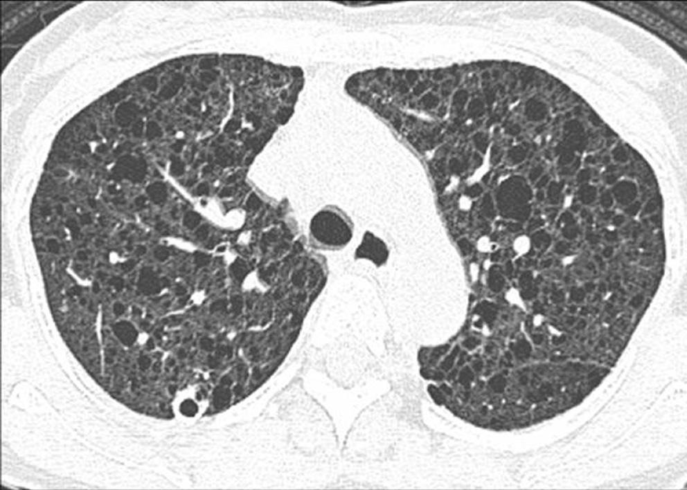 Langerhans cell histiocytosis in a 21-year-old woman. High-resolution CT at the level of carina shows numerous cysts and small nodules in both lungs.