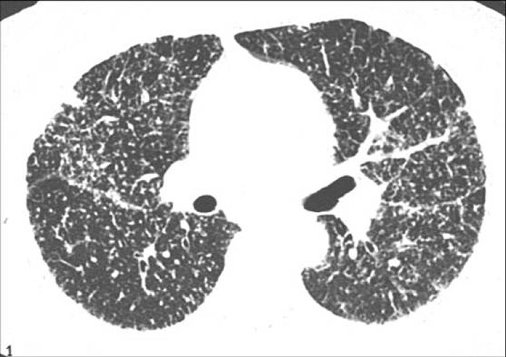 Irregular and bizarre shaped cysts, small centrilobular nodules, and predominantly upper lung involvement in a heavy smoker permit a confident diagnosis of Langerhans cell histiocytosis which was