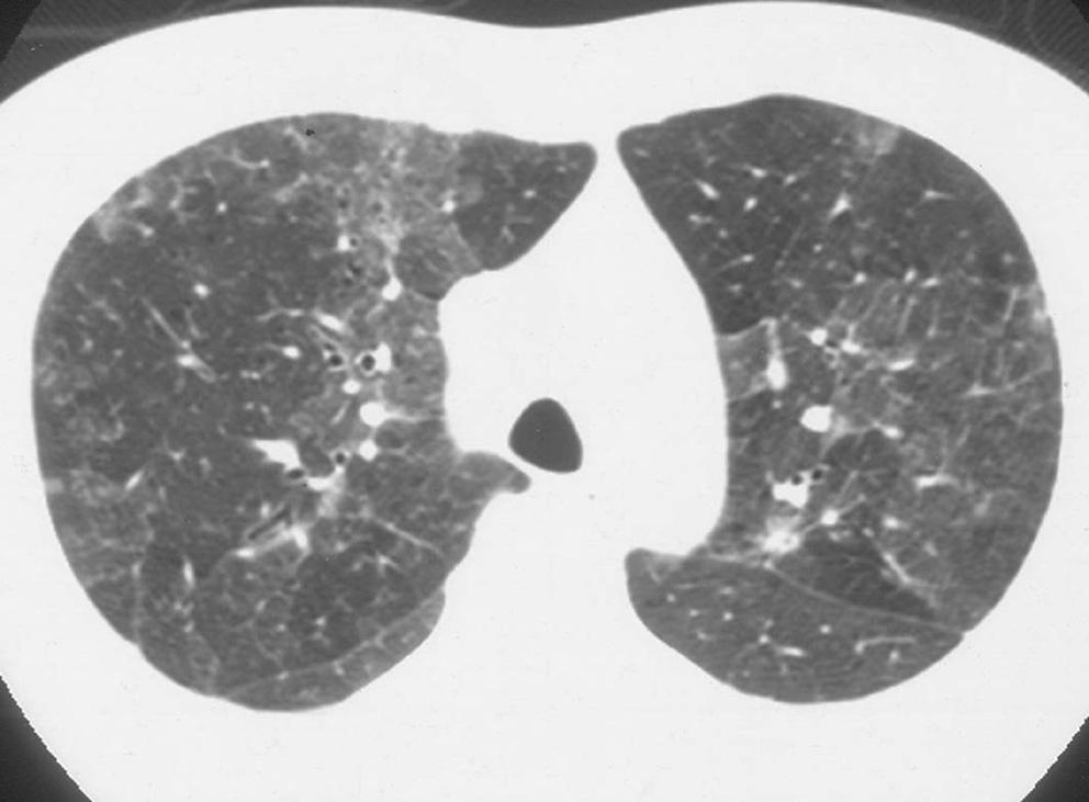 간유리 음영을 보이는 미만성침윤성폐질환으로 는 비특이성간질성폐렴(nonspecific interstitial pneumonia), 호흡성 세기관지염-간질성폐질환, 박리성간질성폐렴, 림프구 Fig. 22. Miliary tuberculosis in a 33-year-old man.